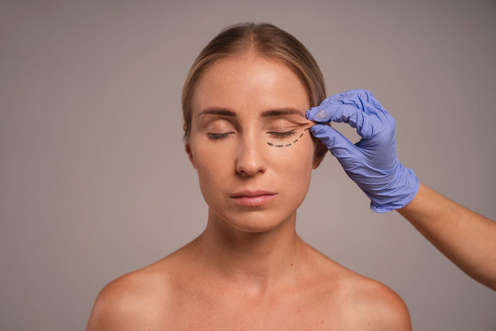 mulher de olhos fechados recebendo marcação na pálpebra inferior feita por profissional usando luvas, indicando preparação para cirurgia de blefaroplastia