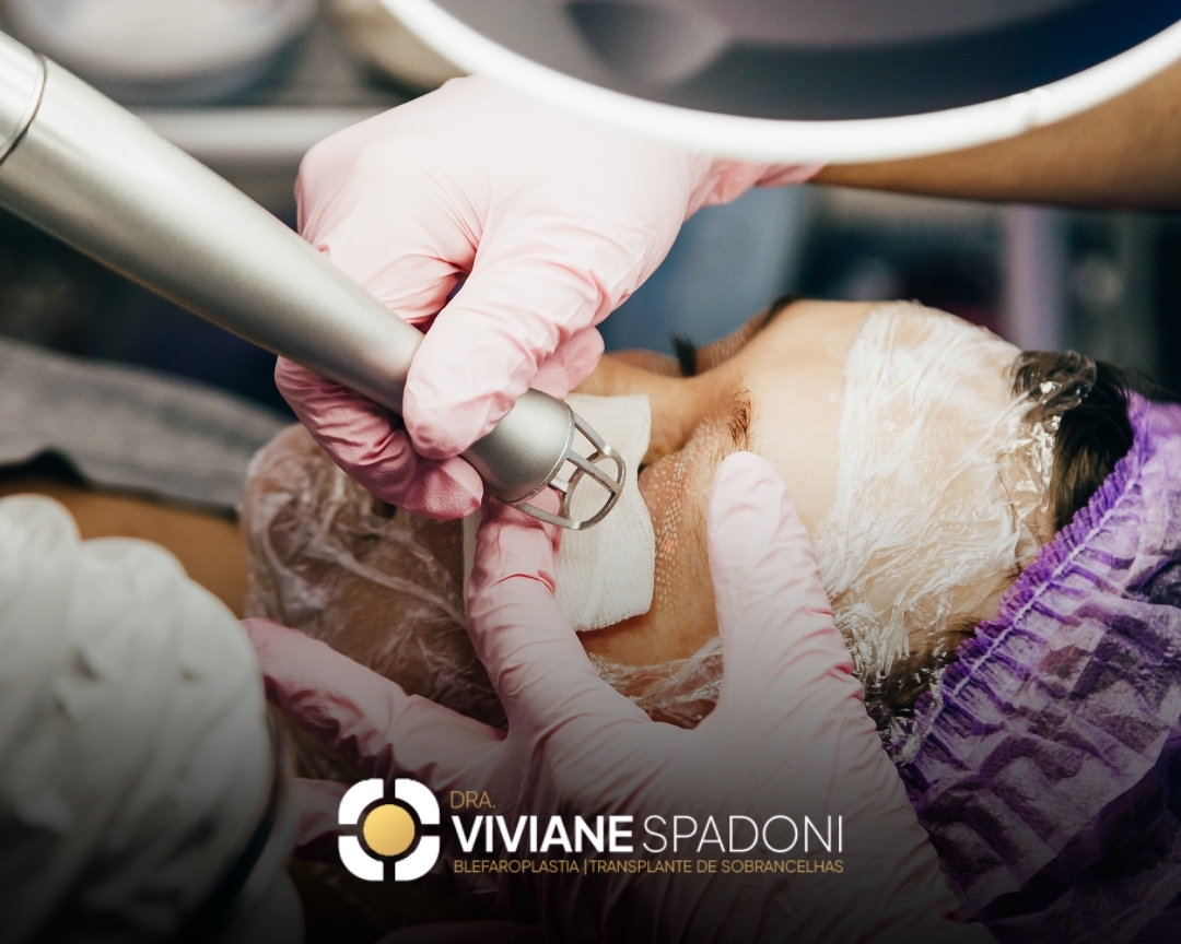Profissional aplicando laser de CO2 na região dos olhos de paciente durante procedimento estético.