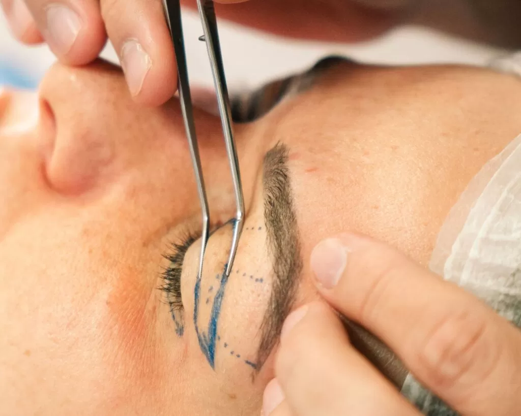 bleafaroplastia recuperação