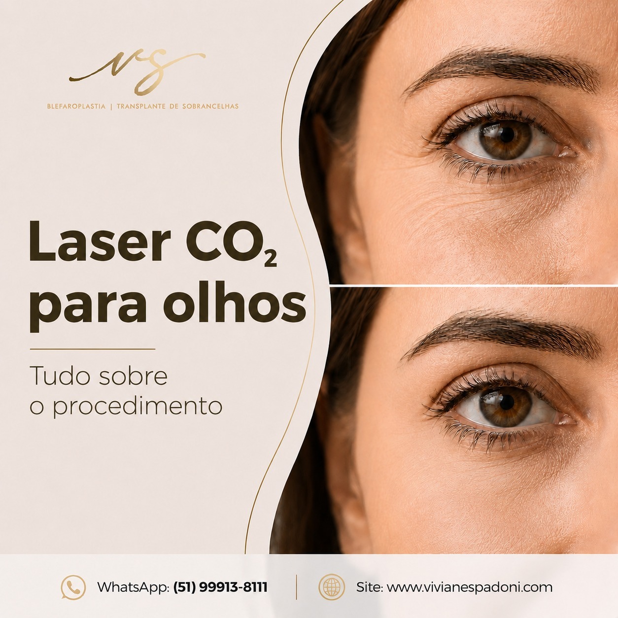 Mas uma das principais dúvidas de quem pesquisa pelo procedimento é: como fica a região dos olhos durante a após esse processo do laser CO₂